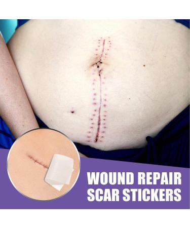Invisible Silicone Scar Sheets | Promotes Circulation | Surgical & Caesarean Scar Removal Strips - Buy Online on GoSupps.com