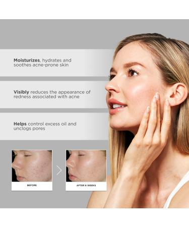 Glytone Acne Treatment Lotion 2 fl. oz. - 1% Salicylic Acid & Bisabolol - For Mild to Moderate Acne - Non-Comedogenic - Buy Online on GoSupps.com