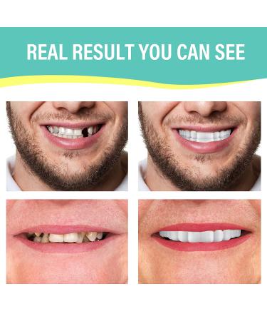 Fake Teeth Veneers Dentures Socket - Regain Confident Smile | 1 Pair - Buy Online on GoSupps.com