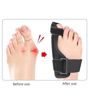 Bunion Corrector & Big Toe Straightener | Pain Relief for Hammer Toe & Hallux Valgus | Bunion Splint & Pads (Right+Left) - Shop Now for International Shipping - Buy Online on GoSupps.com