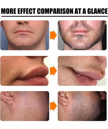 Beard Growth Kit for Men - Derma Roller & Serum for Rapid Growth and Thickening - Buy Online on GoSupps.com