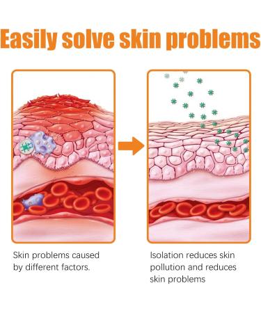 Hhkuize Bee Venom Psoriasis Treatment Cream - Natural Eczema Moisturizing Cream (6PCS) - Buy Online on GoSupps.com