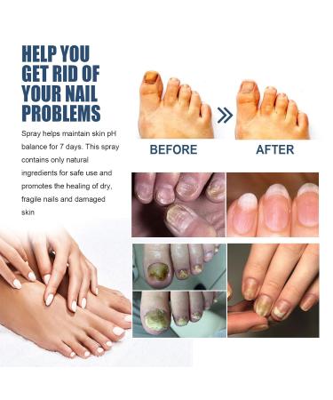 Furzero Medical Grade Nail Foot Spray - Foot Treatment Spray (1pc) - Buy Online on GoSupps.com