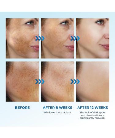 Abera Dark Spot Serum - Dark Spot Corrector for Melasma & Age Spots | Moisturization & Pore Minimizer | All Skin Types | 0.68 fl Oz A - Upgrade Version - Buy Online on GoSupps.com