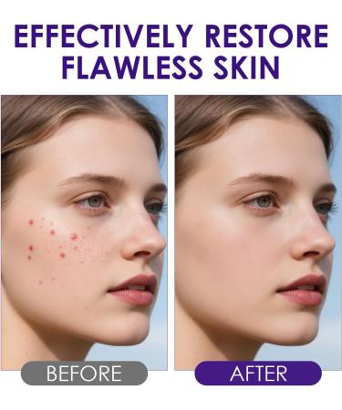 Halercay 20g acne cream reduces the volume of pimples effectively improves pimples on the face removes acne for pimpleprone skin makes the skin look smooth - Buy Online on GoSupps.com