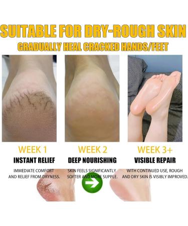  HISUNBEN Moisturizing and anti-crack foot cream with 60% urea - Cream for very dry feet - Heel balm soothes - Buy Online on GoSupps.com