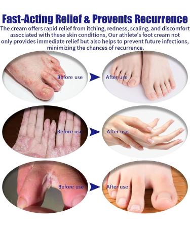 Foot Rash Cream for Itchy Feet Relief - Jock Itch, Ringworm, Psoriasis, Eczema, Athlete's Foot Treatment - Natural 4 Fl Oz - Buy Online on GoSupps.com