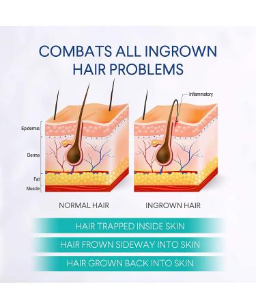 Evagloss Razor Bumps Solution - After-Shave Repair Serum for Ingrown Hairs & Dark Spot Correction | Skin Lightening Roll-On for Men & Women (100g) - Buy Online on GoSupps.com