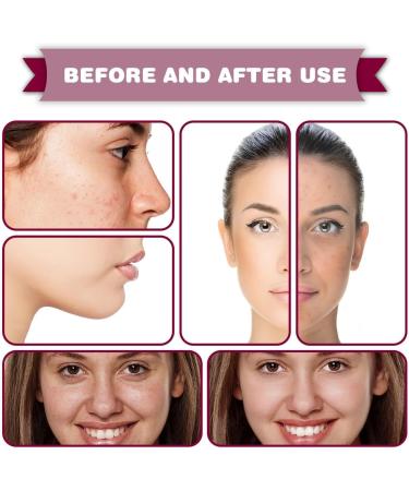 Rosacea Care Rosacea With Natural Moisturizing Fruit Acids Redness Corrector Water Oil Balance Facial Care Improves Skin Relieves Rosacea 30 l - Buy Online on GoSupps.com