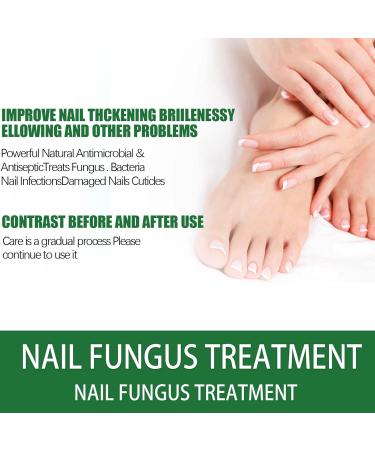 Antifungal Nail Treatment for Toe Fungus - 2-in-1 Solution to Treat and Prevent Nail Fungal Infections - Buy Online on GoSupps.com