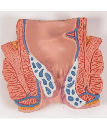 3B Scientific K27 Hemorrhoid Model with Smart Anatomy | Educational Tool - Buy Online on GoSupps.com