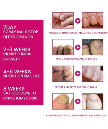  G n rique Strengthener For Damaged Nails - 10ml Reinforced Foot Nail Care | Effective Natural Cuticle Repair Care | Yellow Foot And Nail Care For Feet And Hands - Men - Buy Online on GoSupps.com