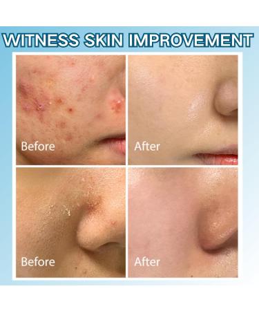 Acne Repair Face Cream - Moisturiser Face Women - Face Moisturizer for Women - Deeply Nourishes Skin - Skin Lightening Cream - Light Texture and Easy Absorption - Buy Online on GoSupps.com