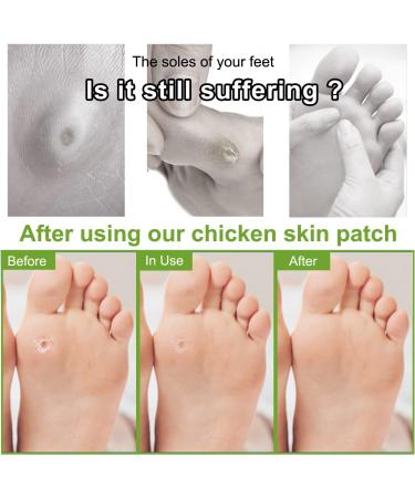 72 Pieces Corn Paving for Stubborn Chicken Eyes Removal - Effective Foot Sole Treatment - Buy Online on GoSupps.com