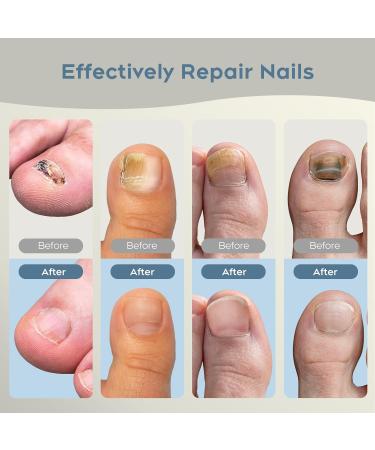 Nail Fungus Light Device for Discolored Nails - 470nm Blue & 905nm Infrared for Home Use Repair Multiple Toenails - Buy Online on GoSupps.com