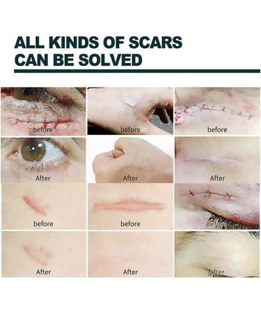 German Advanced Skin Renewal Gel Scar Gel For Acne Scars Stretch Mark Removal Cream Advanced Scar Treatment Natural Scar Therapeuti Gel Scar & Stretch Marks Remover Gel (3pcs) - Buy Online on GoSupps.com