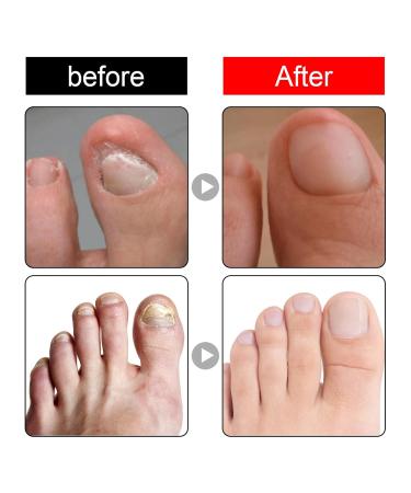 Ingrown Toenail Serum | Nail Care Oil for Brittle & Discolored Nails - 10ml - Hard Nail & Skin Treatment - Buy Online on GoSupps.com