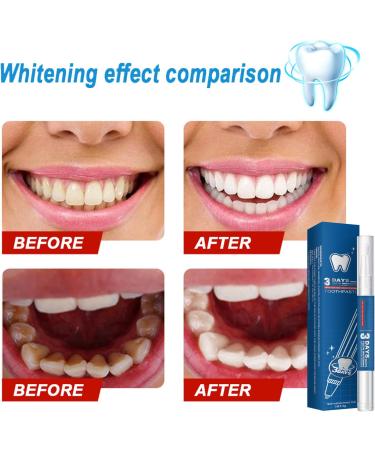 Tooth Whitening Pen - Fast Stain Removal No Sensitivity 4-Piece Set for Bright White Smile - Portable & Easy to Use - Buy Online on GoSupps.com
