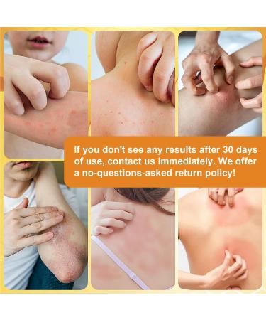 Manuka Honey Draw Salve Cream - Soothing Relief for Seborrheic Dermatitis Eczema Rosacea Psoriasis & Dry Scalp - Buy Online on GoSupps.com