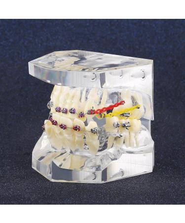 Dental Teeth Model with Metal Brackets - Orthodontic PVC Resin for Dental Schools - Buy Online on GoSupps.com