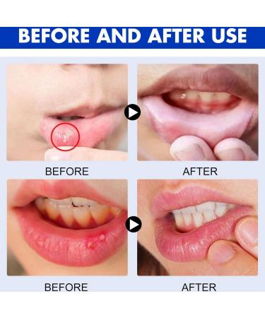 Oral Ulcer Sprays Mouth Ulcer Treatment Spray Ulcer Breath Sprays Mouth Ulcer Spray Canker Relief Spray Ulcer Treatment Tongue Herbal Mouth Spray Breath Freshener Spray Effective Canker Sore Treatment - Buy Online on GoSupps.com