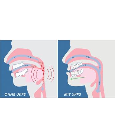 Snorflex Snoring Stopper | Premium Two-Part Anti-Snoring Splint with Elastic Straps & Quick Adjustment - International Shipping Available - Buy Online on GoSupps.com