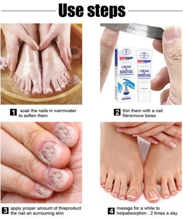 Fungal Nail Treatment Fungus Nail Cream Extra Strong Nail Fungus Treatment for Toenail Fix Renew Damaged Broken Anti Fungus Nail Repair - Buy Online on GoSupps.com