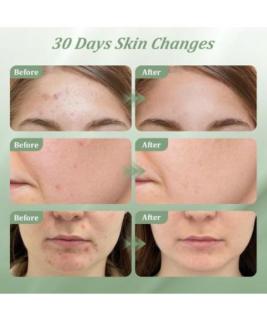 Bablabear 2% Salicylic Acid Acne Treatment Cream for Face Back/Butt/Body Spot Treatment for Pimples Face Blemishes Blackheads Oil Control Ingredients are Natural Suitable for Teenagers/Women/Men(30g) - Buy Online on GoSupps.com