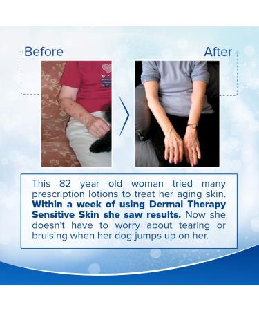 Dermal Therapy Sensitive Skin Lotion - Calming Non-Irritating Lotion with 15% Allantoin 10% Shea Butter Vitamin E - Soothing Relief for Dry Itchy Eczema-Prone Skin - 8 fl oz / 240 ml - Buy Online on GoSupps.com