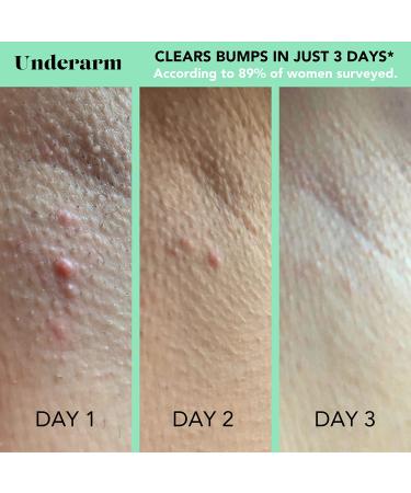 SweetSpot Labs Ingrown Hair Removal Kit | Razor Bump Treatment Set for Bikini Area, Body, and Underarms | Gentle on All Skin Types - Buy Online on GoSupps.com