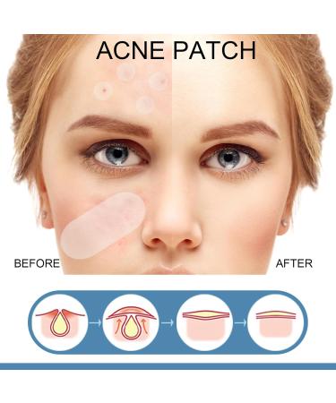 Pimple Patches Acne Stickers Hydrocolloid Patches Large Acne Stickers for Face Chin or Body Effectively Calms & Relieves Acne (80 Patches) - Buy Online on GoSupps.com