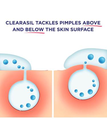 Clearasil Stubborn Acne Control Exfoliating Wash 5-in-1 - 6.78 fl oz (200 ml) - Buy Online on GoSupps.com