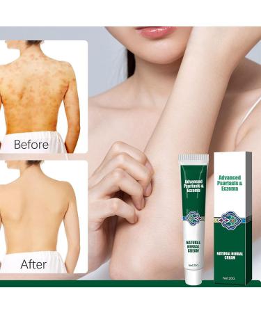 2PCS Herbal Itching Relief Ointment for Eczema Rash Repair - Moisturizing Cream for Dry, Irritated Skin - Buy Online on GoSupps.com