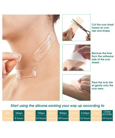 Silicone Scar Removal Sheets - C-Section, Surgery, Burns, Acne, Stretch Marks - 4 Sheets - Buy Online on GoSupps.com