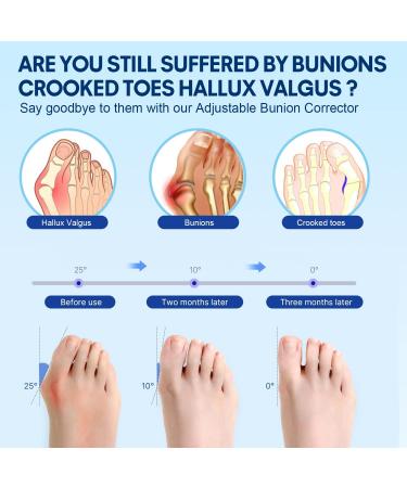 Bunion Corrector for Women & Men - Toe Separator & Straightener for Pain Relief - Hallux Valgus Brace - Lightweight, Comfortable & Reusable - One Size - Buy Online on GoSupps.com