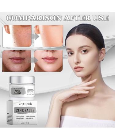 Luyuttn 2 Pieces Zinc Ointment Against Pimples with Tea Tree Oil Body Acne Cream Cream Against Pimples AntiBlackhead for Face and Buttocks Back and Thighs - Buy Online on GoSupps.com