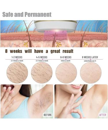 ZRXFX IPL Hair Removal Device - Painless Full Body Laser Treatment for Smooth Skin - Buy Online on GoSupps.com