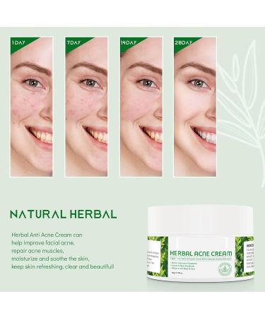 Antiacne cream face cream face cream antipimples quickly reduces blemishes targeted solution against pimples - Buy Online on GoSupps.com
