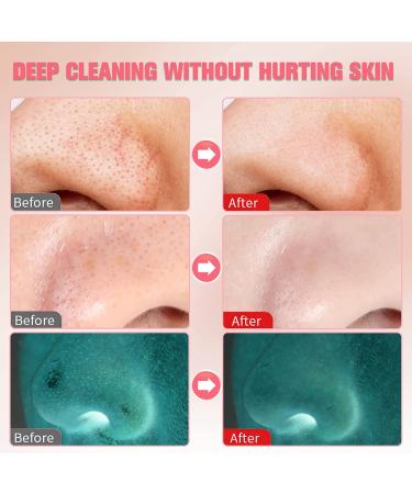 Blackhead Remover Pore Vacuum - LED Screen, USB Rechargeable Cleanser with 3 Suction Power Levels - For Acne, Whitehead Removal - 4 Probes - Women & Men - Buy Online on GoSupps.com