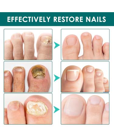 Cr me de soin des ongles formule r paratrice intense pour ongles des mains et des pieds pour ongles des mains et des pieds professionnelle facile utiliser pour hommes et femmes - 20 g - Buy Online on GoSupps.com
