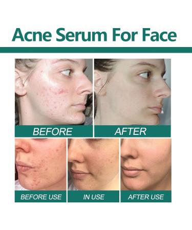 Acne Scar Fading Serum Pore Minimizing Hydrating Essence - Brightens & Repairs Skin Makes Skin Smooth Easy To Use(2PCS) - Buy Online on GoSupps.com