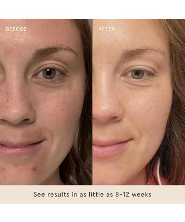 Barefaced Brightening Serum Dark Spot Corrector | Kojic Acid Arbutin Azelaic Acid & Licorice | Anti-Aging Hydrating | Antioxidant-Powered Formula Fades Hyperpigmentation & Evens Skin Tone (1 Oz) - Buy Online on GoSupps.com