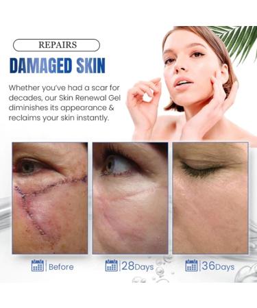 NUANYOYO Silvive Advanced Silicone Scar Removal Gel - Reduces Old & New Scars (1 Bottle) - Buy Online on GoSupps.com