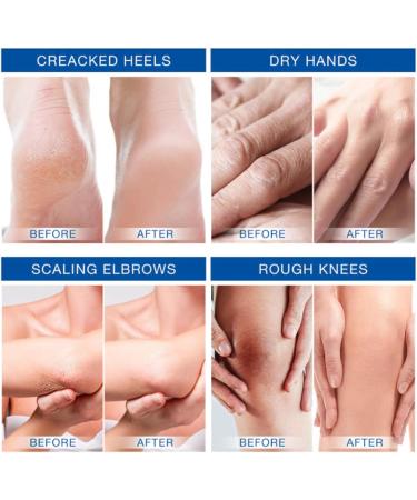 Urea Foot Cream 40 Percent - Urea Cream Plus 2% Salicylic Acid - Cracked Heel Repair Cream - Urea Cream for Feet with Coconut Oil Tea Tree and Aloe Vera - Callus Remover and Soften - Buy Online on GoSupps.com