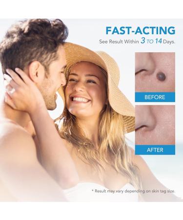 JIAWEIIY 2-in-1 Auto Skin T_ag Removal Kit for Skin T_ag (2-8mm) Skin T_ag Remover Device for Skin T_ags Fast and Easy Skin T_ag Remover Pen Device - Buy Online on GoSupps.com