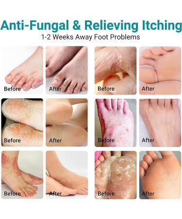 LMNOOP Athletes Foot Treatment Cream Maximum Strength - Antifungal Foot Cream for Itching, Blister, Burning, and Cracking - Natural Herbs - 1.76oz - Buy Online on GoSupps.com