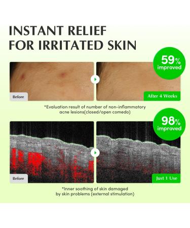 EQQUALBERRY Aloe PDRN Calming Toner for Sensitive | Instant Relief & Cooling | Non-Comedogenic & Fungal Acne Safe Skin Barrier Repair | K-Beauty (5.07 fl.oz / 150ml) - Buy Online on GoSupps.com