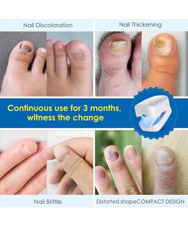 Nail Fungus Cleaning Laser Device Anti Fungal Laser Nail Fungus Laser Treatment for Damaged Discolored Thick Toenails & Fingernails Nail Therapy for Onychomycosis Easy to Use at Home - Buy Online on GoSupps.com