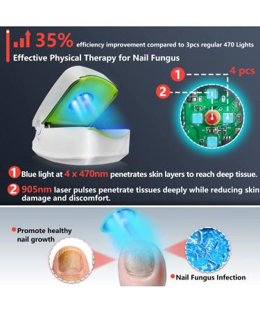 Nail Fungus Laser Treatment Device - Home Treatment for Healthy Nails and Toenails (White) - Buy Online on GoSupps.com