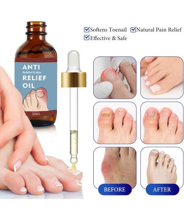 Ingrown Toenail Treatment 30ml Ingrowing Toenail Treatment Toenail Anti Paronychia Relief Oil Correction Ingrown Toenail Softening Drops for Damaged Discolored Thick Nail - Buy Online on GoSupps.com